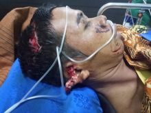 Warga Inhil yang diterkam harimau saat ini masih dirawat/rgo