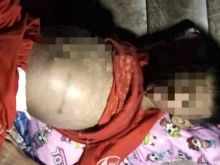 Bocah malang bernama Riski Aril (7) butuh uluran tangan karena mengalami penyakit tumor ganas (foto/Hari)