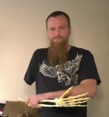 Pria Kanada Ini Begitu Terpikat Dengan Lengannya yang Sudah Diamputasi, Dan Ia Selalu Membawanya Kemana-mana Selama 20 Tahun