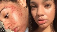 Punya Wajah Hancur, Wanita Ini Membersihkan Jerawatnya Dengan Produk Alami, Ini yang Terjadi 30 Hari Kemudian