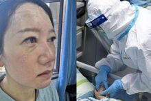 Kondisi Wajah petugas medis usai memakai masker selama berjam-jam/Twitter/ @CGTNOfficial