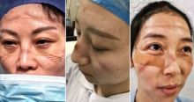 Foto-Foto Luka Pada Wajah Perawat Akibat Kacamata Pelindung Menunjukkan Kerasnya Pekerjaan Mereka Pasca Virus Corona