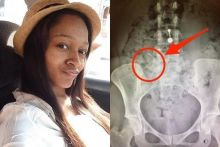 Tanai Smith harus kehilangan rahim, Indung Telur, dan kakinya diamputasi 