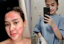 Sering Muncul Gejala Aneh Pada Kulit Tubuh Selama 5 Tahun, Cita Citata Operasi Penyakit Ini (foto/int)