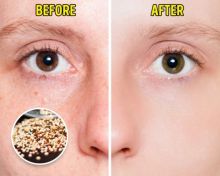 Buat Para Ladies, Ini Lho 7 Makanan Yang Bisa Mengurangi Bekas Jerawat di Wajah Kamu...