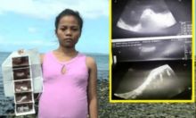 Perut Membesar Seperti Hamil, Dituduh Bersetubuh Dengan Ikan, Ternyata Dalam Perut Wanita Ini Bukan Janin Tapi Kista (foto/int)