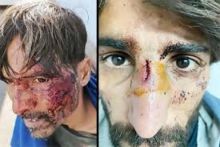 Kasihan, Pengungsi di Kroasia Ini Alami Luka Parah Setelah Dicambuk, Dipukuli dan Dilecehkan Secara Seksual