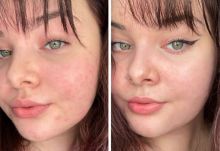 Apa Yang Dapat Terjadi pada Kulit Anda Saat Anda Mengoleskan Es Di Wajah Setiap Hari (foto : © prettygirl527 / Reddit)