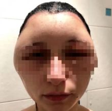 Kepala Wanita Ini Membengkak Gara-gara Cat Rambut (foto/int) 