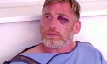 Alexander Lashkarava, 37, mengalami patah tulang di wajah setelah diserang Senin lalu. Foto: Tv Pirveli/Reuters