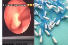 Tiap Hari Pakai Cotton Bud, Setelah Telinga Pria Tersebut Diperiksa Dokter Ternyata Tumbuh Jamur (foto/int)