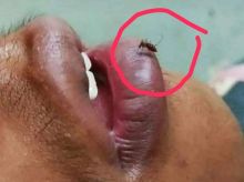 Digigit Nyamuk Jangan Digaruk, Ini Cara Ampuh Redakan Rasa Gatal (foto/int)