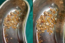 Batu-batu itu menyebabkan pasien berusia 56 tahun menderita sakit parah di pinggang kiri selama lebih dari enam bulan. (Foto: IANS)