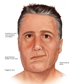 Ramsay Hunt Syndrome/net