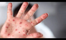 Kasus cacar monyet meningkat di Amerika Serikat, New York umumkan darurat kesehatan /net