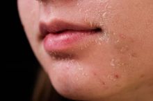 ILUSTRASI: Potret Kulit Kering Mengelupas. (Halodoc/Foto)