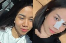 Potret Before- Afternya Mayang Jalani Operasi Plastik Pada Bagian Hidung. (Twitter/Foto)