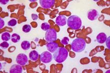 Leukemia