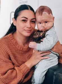 Kasihan, Ibu Ini Disebut Monster karena Laser Wajah Bayinya untuk Hilangkan Tanda Lahir