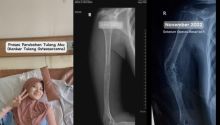 Awal Mula Wanita Bandung Idap Kanker Tulang, Diduga gegara Diurut dan Riwayat Jatuh