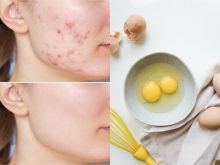 Apakah Telur Menyebabkan Jerawat? Faktanya Cek di Sini... (X/Foto)