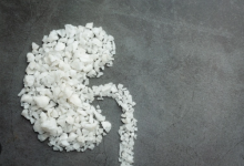 Dokter Temukan 300 Batu Ginjal di Tubuh Wanita Taiwan Gegara Sepelekan Hal Ini... (Siloam Hospitals/Tangkapan Layar)