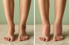 Apa Sebenarnya Pembengkakan di Berbagai Bagian Tubuh Tentang Kesehatan Anda