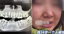 Wanita Tiongkok Jatuh dari Lantai 11 Rumah Sakit Setelah Dokter Gigi Salah Mencabut Gigi 