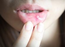 Sariawan Tak Kunjung Sembuh? Bisa Jadi Tanda Imun Lemah