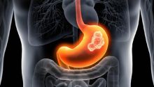 Gejala Kanker Lambung yang Harus Diwaspadai, Kerap Diabaikan gegara Mirip GERD