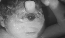 Bayi Ini Terlahir dengan Mata Satu dan Tanpa Hidung, Cuma Bertahan 6 Jam
